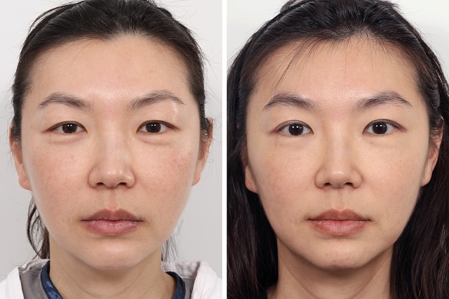 Instagram post by Dr. Jessica Lattman: Our lovely patient 1 month after upper lid blepharoplasty and endoscopic brow lift. She’s absolutely thrilled with her natural and impactful…