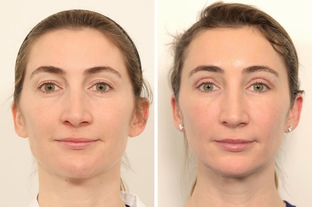 Instagram post by Dr. Jessica Lattman: This lovely patient is one week postop from an upper lid blepharoplasty and nano fat grafting to the lower lids performed by me and an endos…