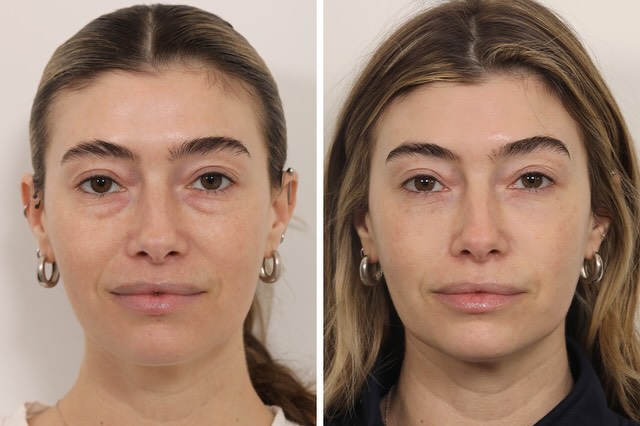 Instagram post by Dr. Jessica Lattman: My lovely patient is one month postop after a lower lid blepharoplasty and nano fat grafting to her lower eyelids. She’s thrilled with her r…