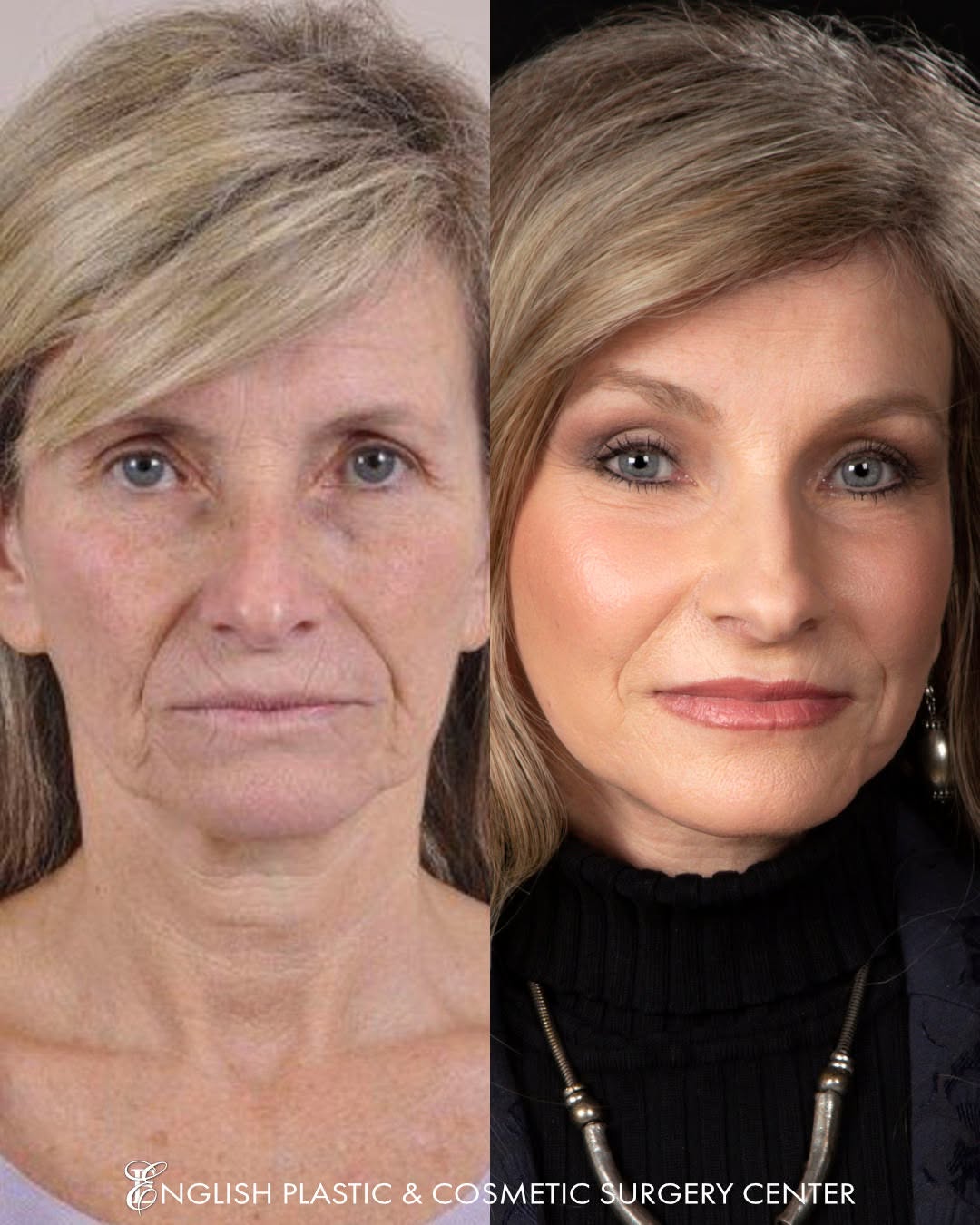Instagram post by Dr. Jim English: Gorgeous! Dr. English performed a lower facelift, brow lift, fat transfer, chemical peel, and dermabrasion on this lovely patient, and her t…