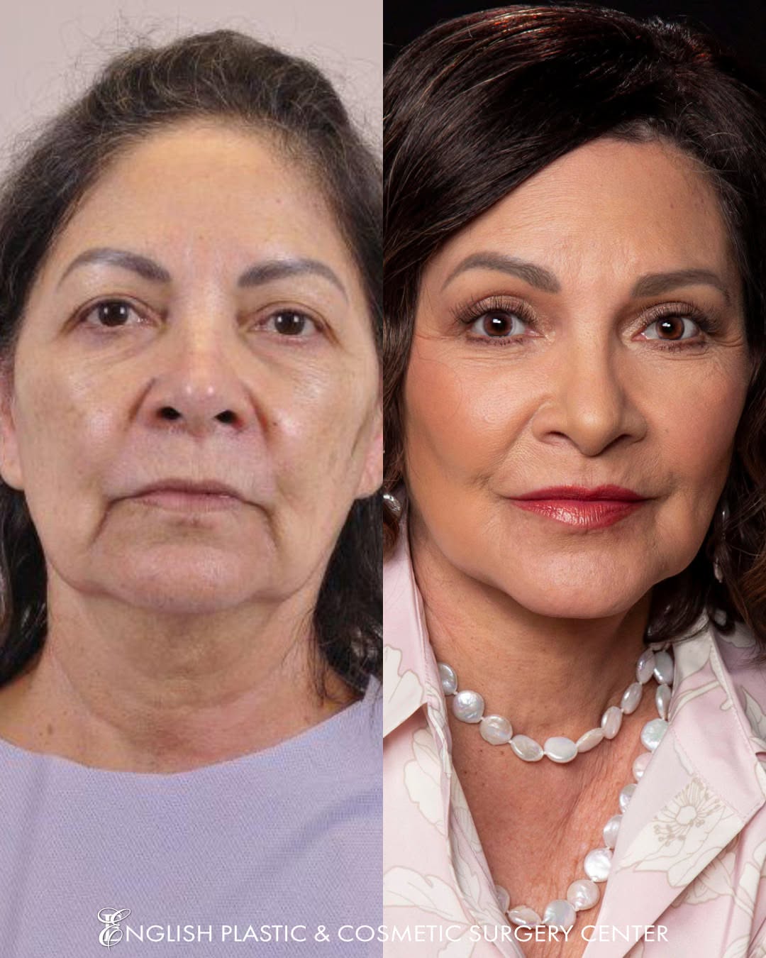 Instagram post by Dr. Jim English: GORGEOUS! Dr. English is a MASTER artist, with a lifetime of experience in beautiful transformations. This patient is absolutely GLOWING wit…