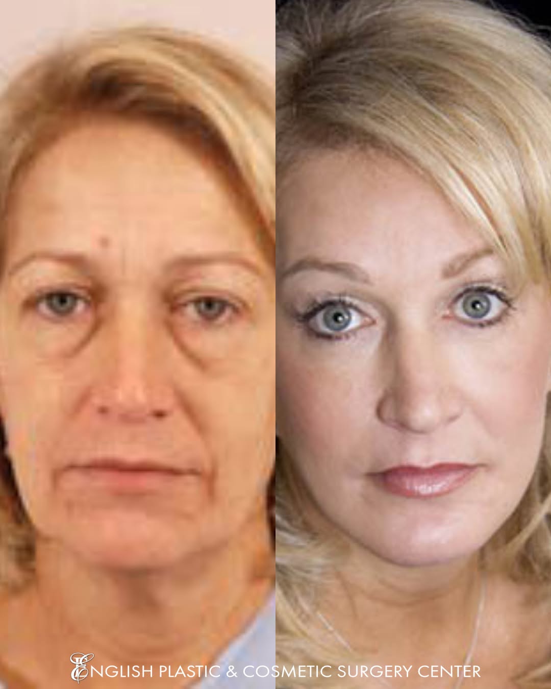 Instagram post by Dr. Jim English: Gorgeous! This beautiful patient perfectly highlights the amazing transformation one can expect from a facelift (lifting sagging or loose sk…