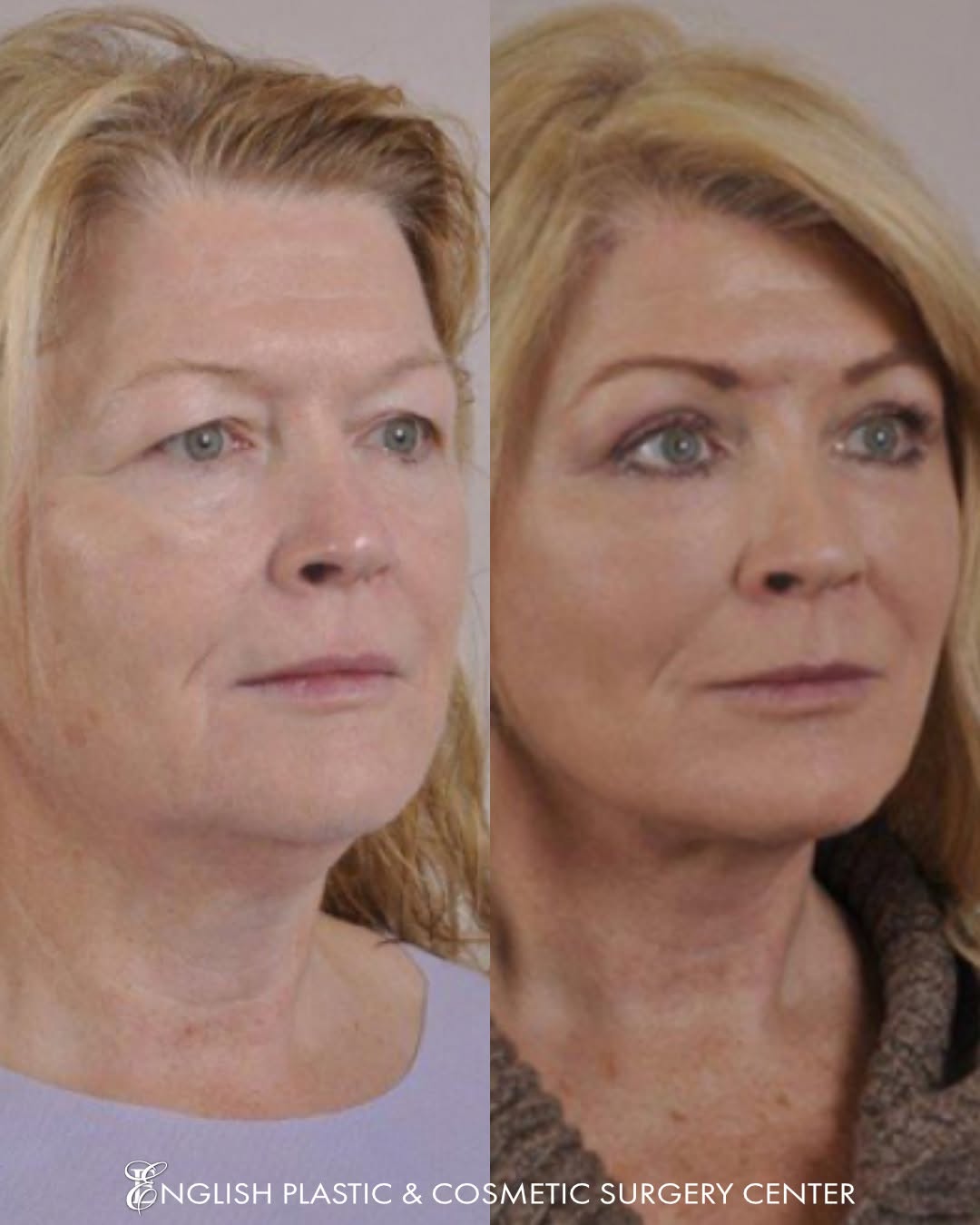 Instagram post by Dr. Jim English: Stunning! This beautiful patient received a facelift, brow lift, eyelid surgery (blepharoplasty), facial liposuction, fat transfer, dermabra…