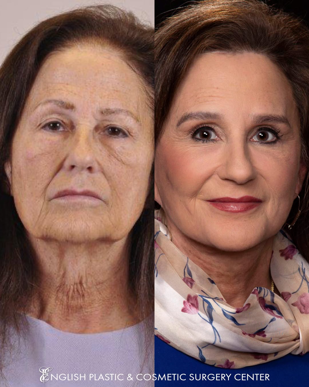 Instagram post by Dr. Jim English: Wow. Just WOWWW! What a GORGEOUS transformation! Our patient chose to live beautifully... the changes are stunning, especially around her ey…