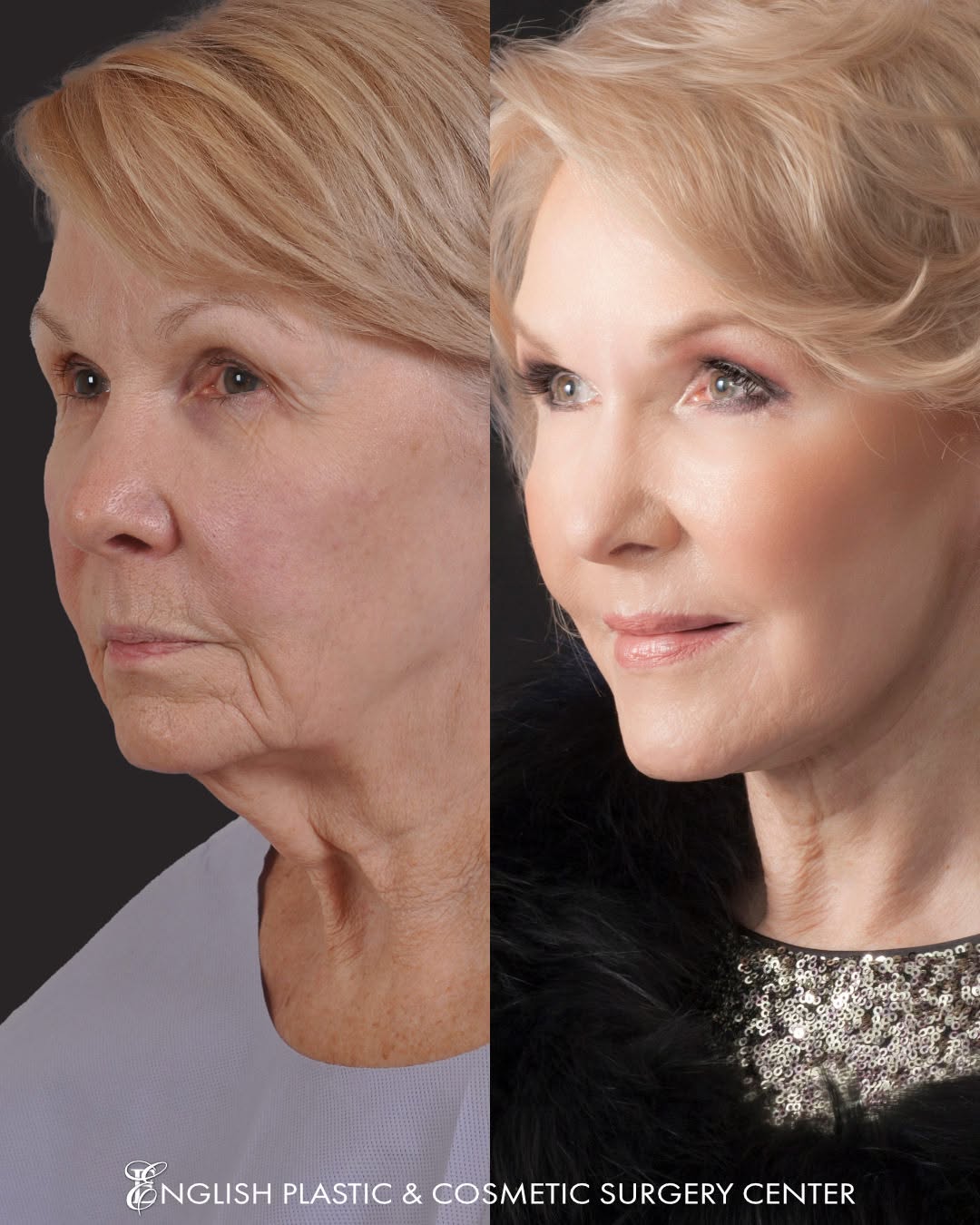 Instagram post by Dr. Jim English: Simply STUNNING! Our patient chose to live beautifully, and is thrilled with the results. Dr. English is a master artist in cosmetic surgery…