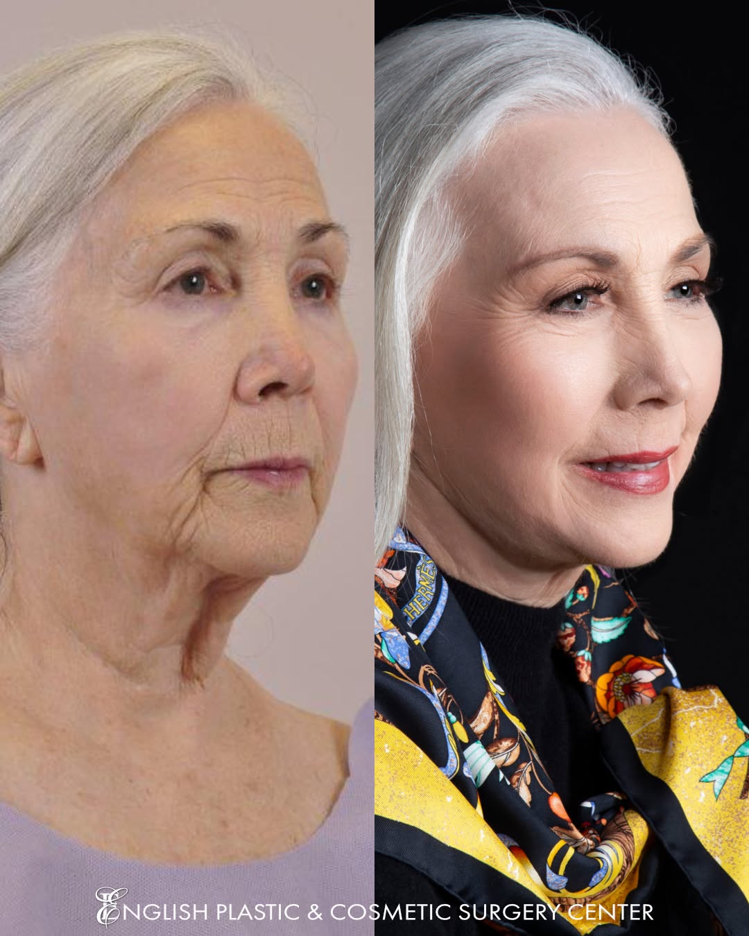 Instagram post by Dr. Jim English: GORGEOUS! Dr. English is a MASTER artist, with a lifetime of experience in beautiful transformations. This patient is absolutely GLOWING wit…