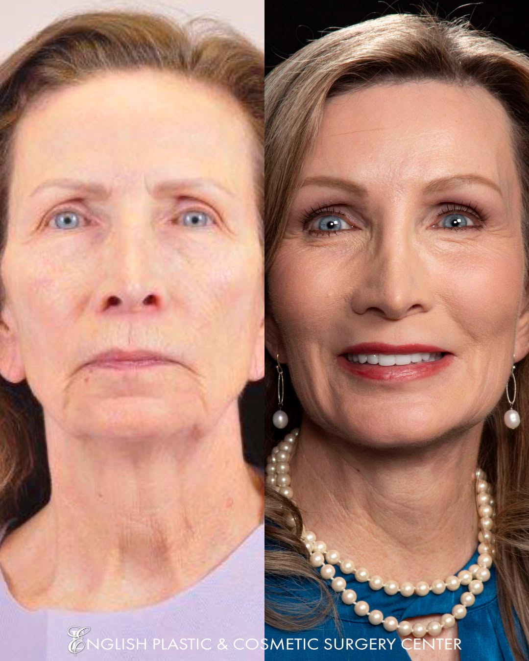 Instagram post by Dr. Jim English: What a GORGEOUS transformation! Our patient chose to live beautifully... and now she GLOWS. She is vibrant and looks so much younger and tim…