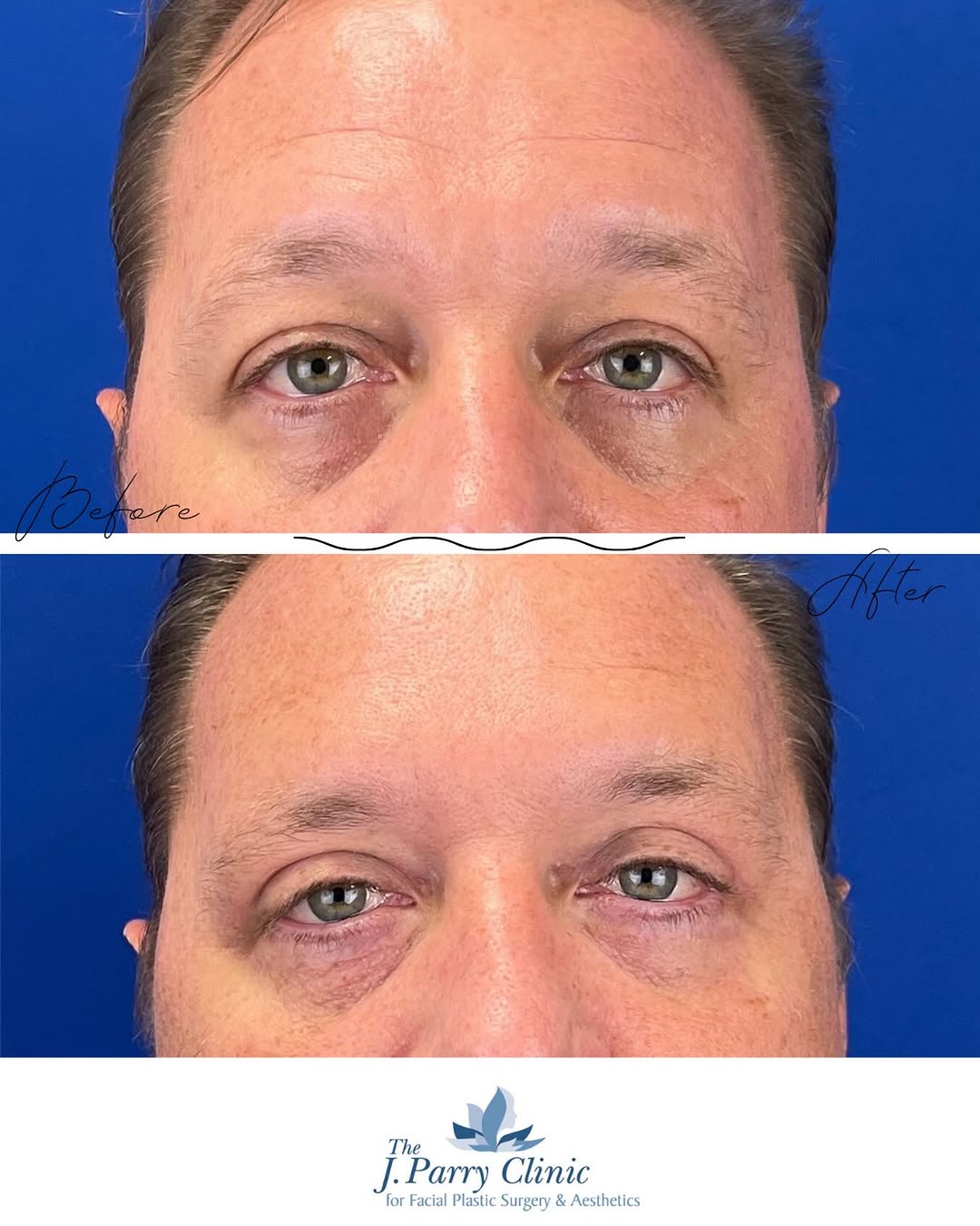 Instagram post by Dr. Jim Parry, DO: Men are choosing subtle eye rejuvenation—and the results speak for themselves. Male blepharoplasty paired with Botox helps restore a rested,…