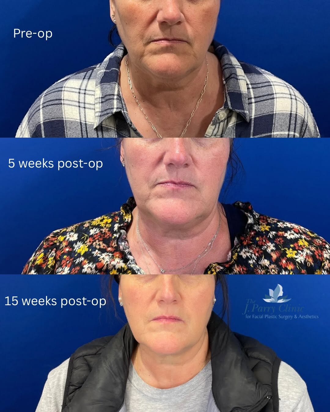 Instagram post by Dr. Jim Parry, DO: Before & After: FaceTite™ + Liposuction This in-office procedure combines radiofrequency skin tightening with precision liposuction to impro…