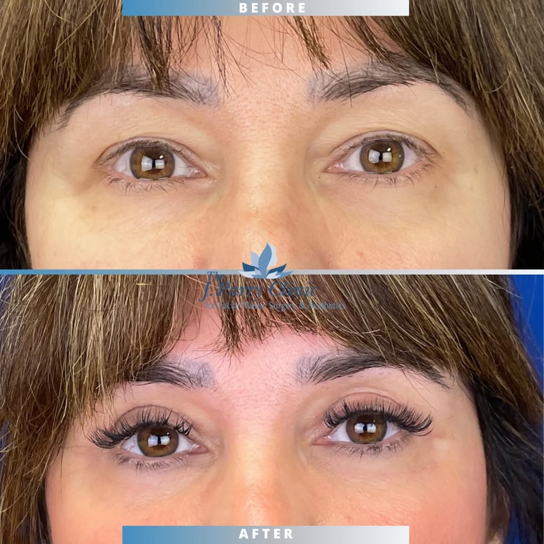 Instagram post by Dr. Jim Parry, DO: This is what we would consider a HOMERUN ⚾️ Upper blephy & lower eyelid skin pinch is Dr. Parry’s favorite surgery to do! We were able to re…