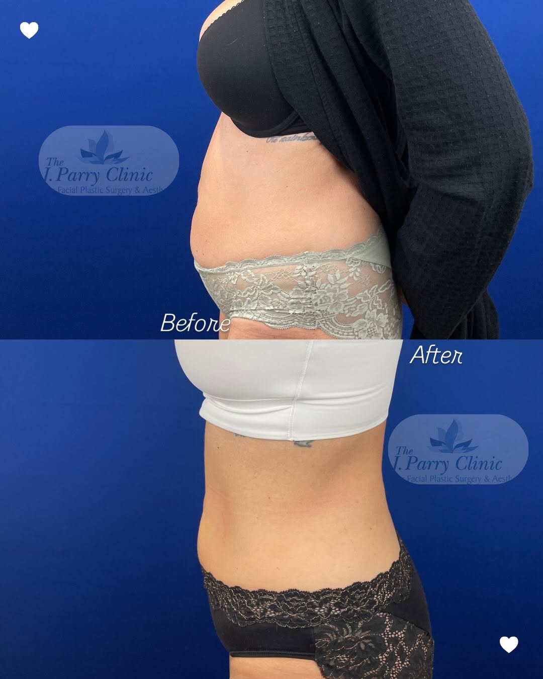 Instagram post by Dr. Jim Parry, DO: Before & After ✨ These BodyTite results show smoother contours and a more sculpted appearance with minimally invasive skin tightening and fa…