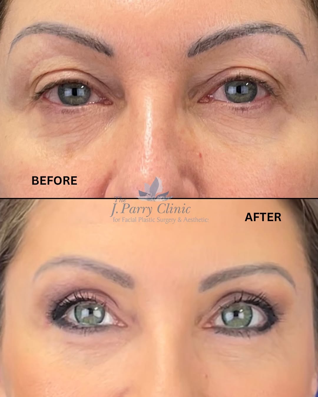 Instagram post by Dr. Jim Parry, DO: This 3-month comparison showcases the results of upper eyelid surgery with a lower eyelid skin pinch procedure performed in the office under…