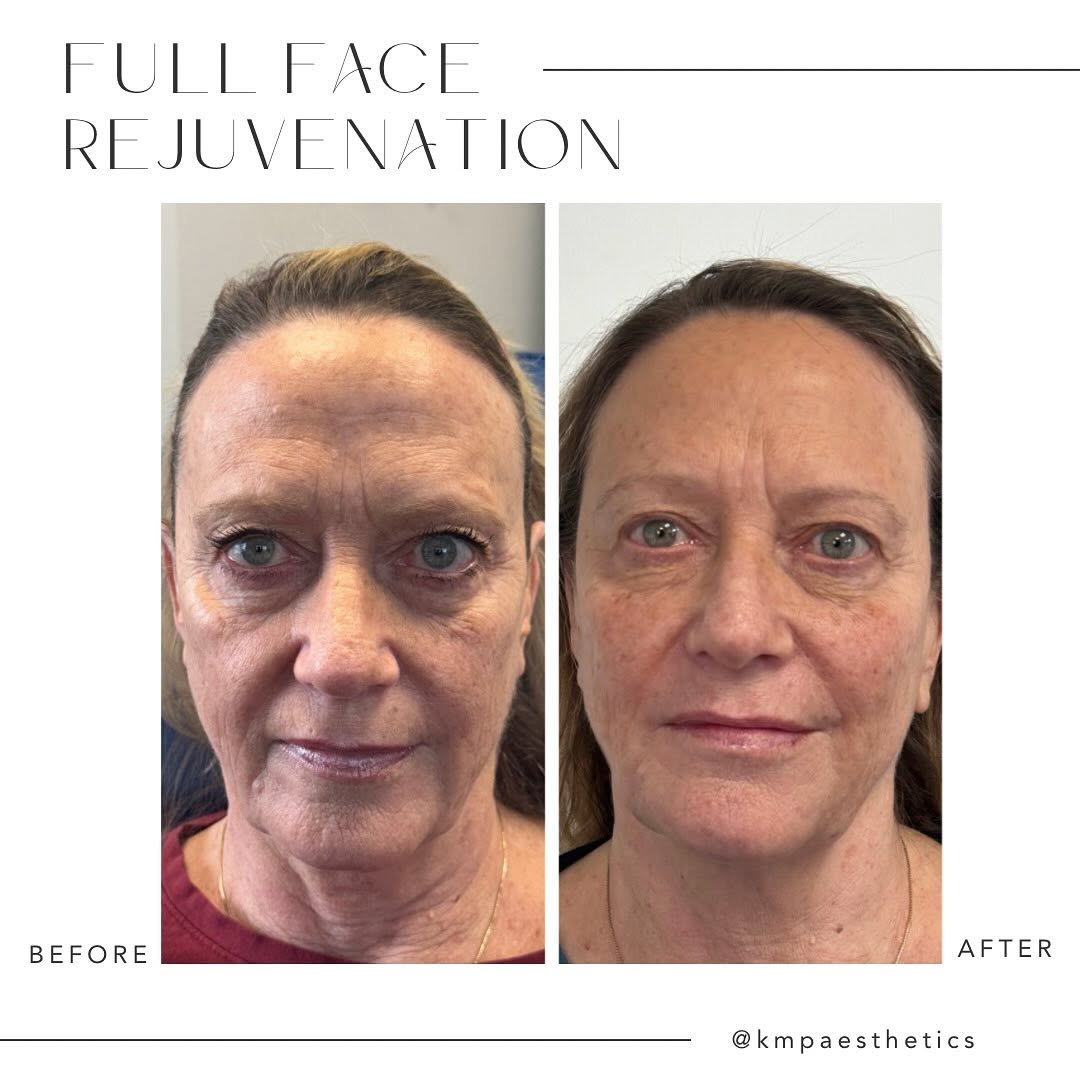 Instagram post by Dr. Jodie Reinertson: 💆🏻♀️Full face rejuvenation with Hyaluronic Acid fillers! 🫶🏻The focus was on the mid face, chin and jawline. 🌟The after photo was taken…