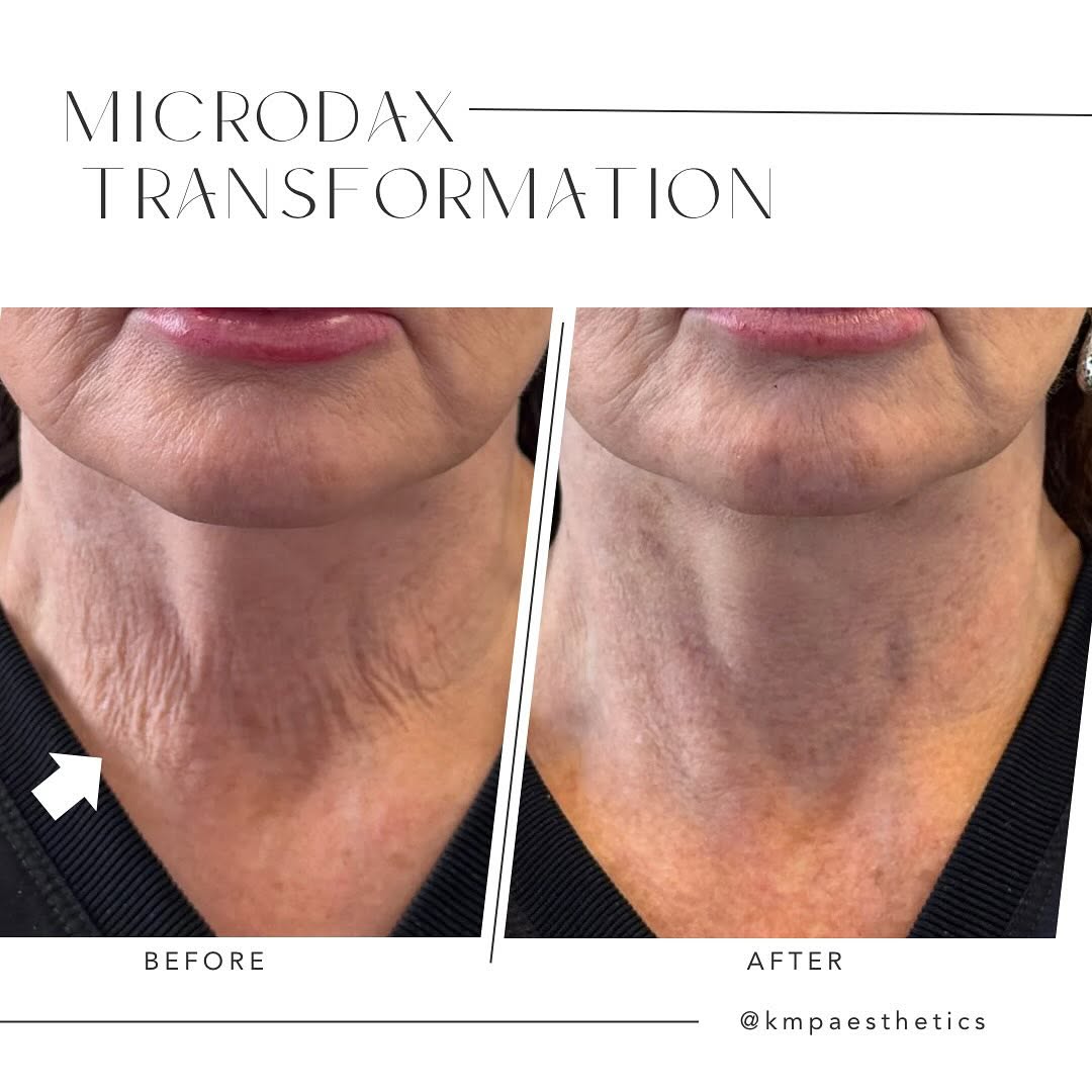 Instagram post by Dr. Jodie Reinertson: ✨MicroDax Magic! 🪄 💆🏻♀️ 💉What is MicroDax ? MicroDaxx is Daxxify, a neuromodulator, that is hyper-diluted with saline and injected supe…