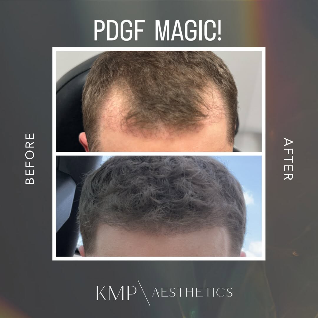 Instagram post by Dr. Jodie Reinertson: PDGF+ for hair restoration 😱