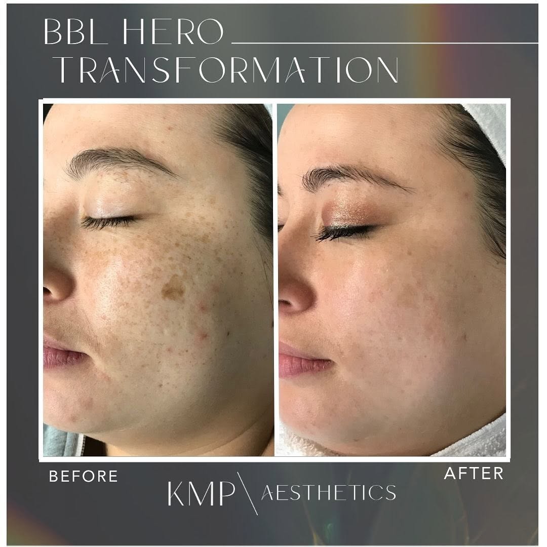 Instagram post by Dr. Jodie Reinertson: Why do we love BBL? Let’s count the ways....🤓 💥 Restores damaged skin by targeting pigmentation and redness 💥Lightens, brightens and impr…