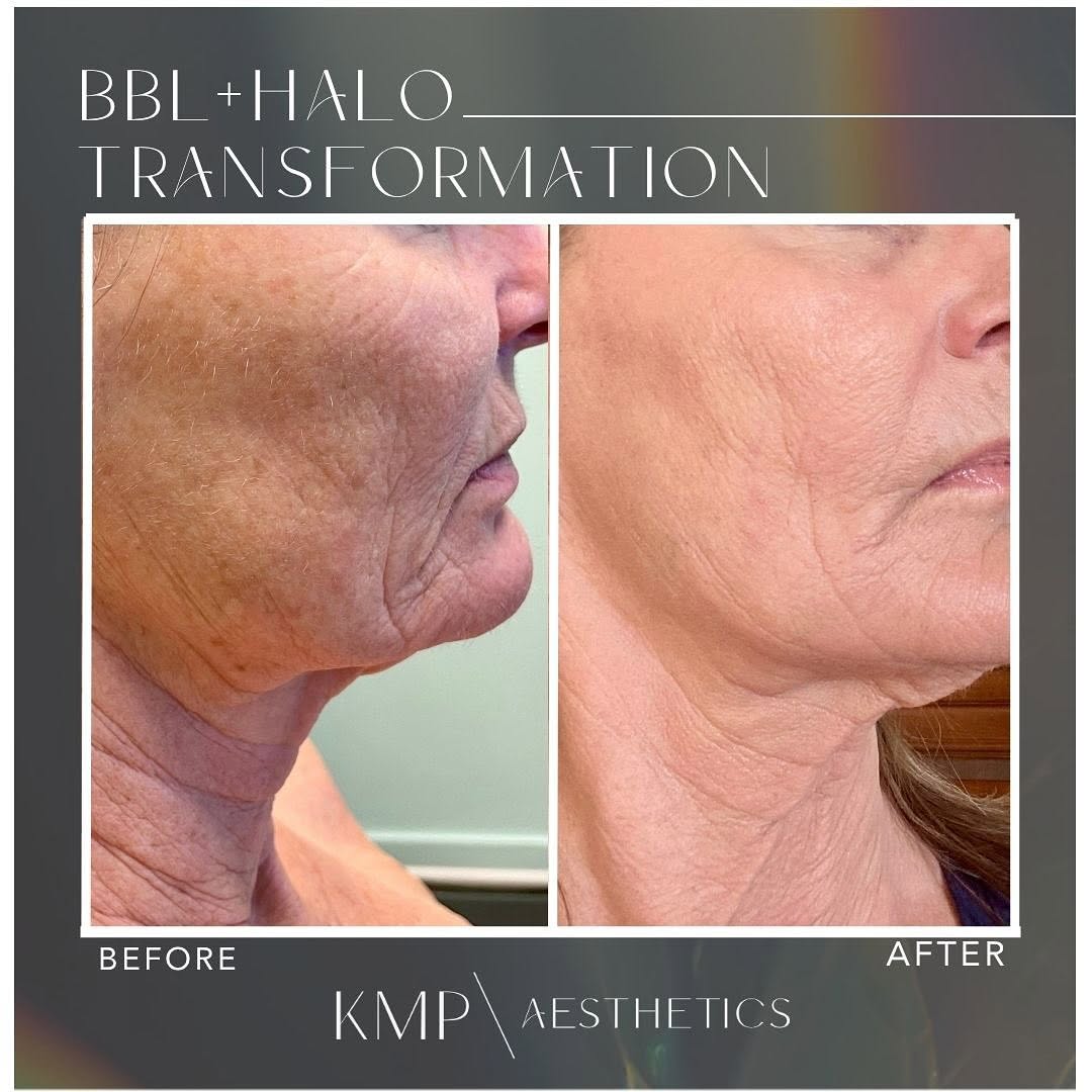 Instagram post by Dr. Jodie Reinertson: 💥These photos are before and after ONE combination treatment! ⚡️This magical combo improves texture, lightens pigmentation and redness, red…