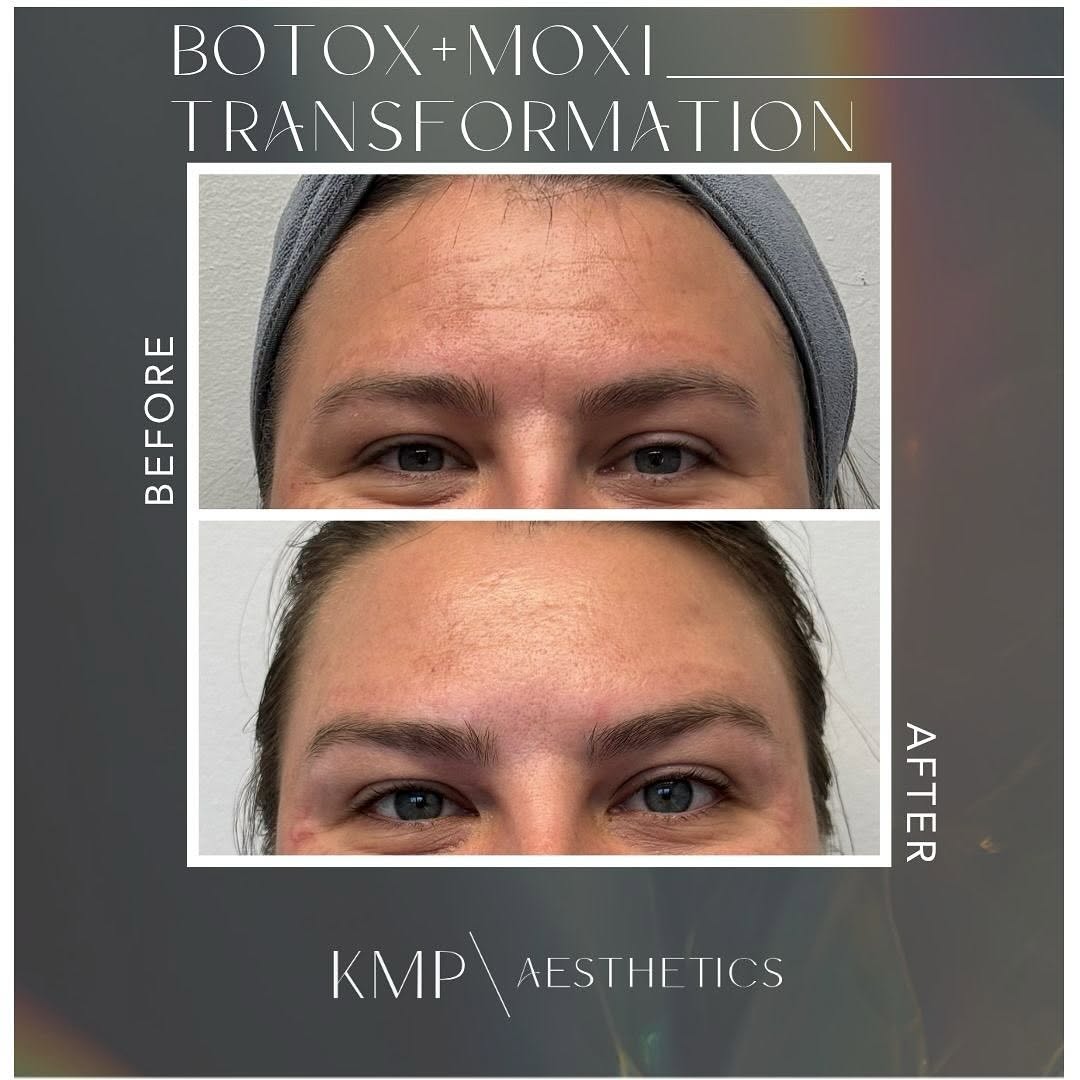 Instagram post by Dr. Jodie Reinertson: 💉 Botox + Moxi 💥 laser…wrinkles gone and texture smooth!! 🙌🏻👯