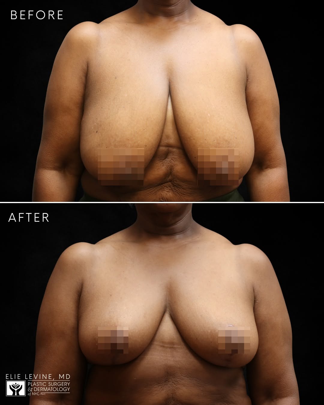 Instagram post by Dr. Jody A. Levine: 36F ➡️ 36C with a breast reduction by Dr. Elie Levine After losing weight, this patient wanted to further refine her results and sought a sm…