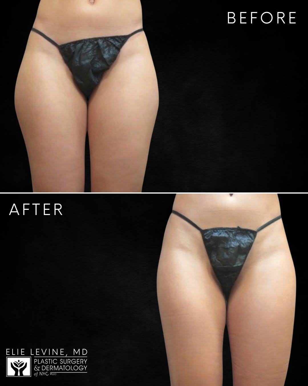 Instagram post by Dr. Jody A. Levine: Outer thigh liposuction by Dr. Elie Levine.