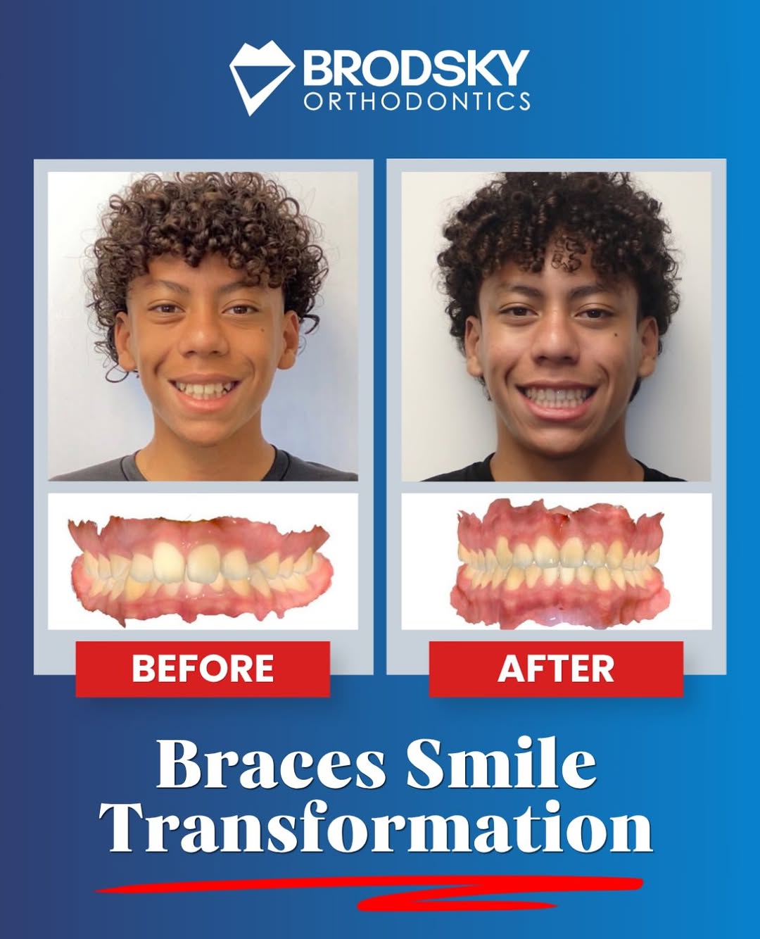 Instagram post by Dr. Joel F. Brodsky, DDS: Marlon just completed 2 years of braces and the result is a confident smile! Take a look at his before & after to see the transformation. 🙌…