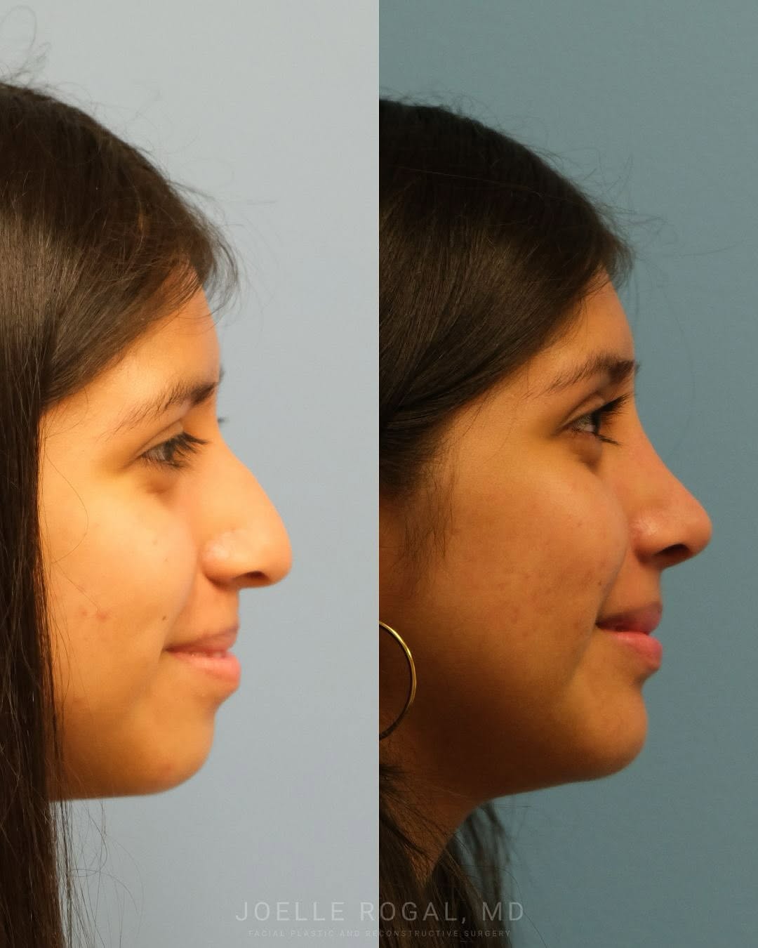 Instagram post by Dr. Joelle Rogal: What a difference a year can make! This patient is seen before and one year after a primary rhinoplasty.
