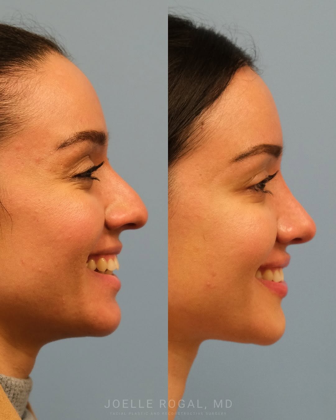 Instagram post by Dr. Joelle Rogal: 1.5 years following a primary rhinoplasty to refine and lift the tip. Notice the improved balance, softer profile, and natural look. Contact…