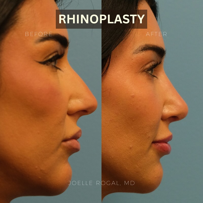 Instagram post by Dr. Joelle Rogal: 6 months following a primary functional and cosmetic rhinoplasty. Her breathing is improved and the nose is straighter and more refined. Con…