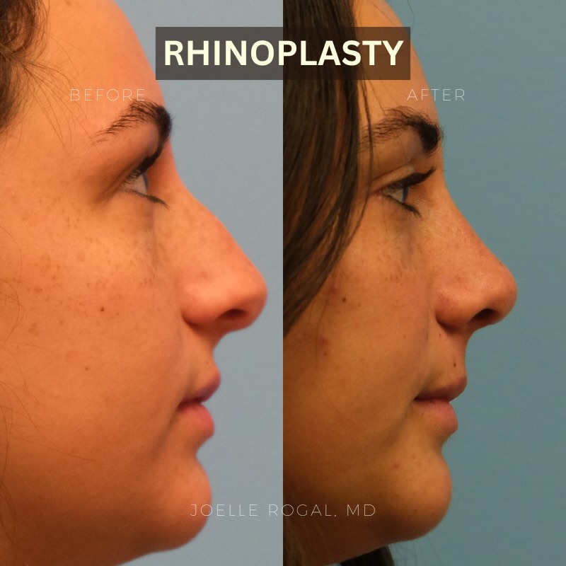 Instagram post by Dr. Joelle Rogal: 6 months following a primary rhinoplasty to straighten the nose, refine the tip, and reduce the dorsal hump. Contact our office to schedule …