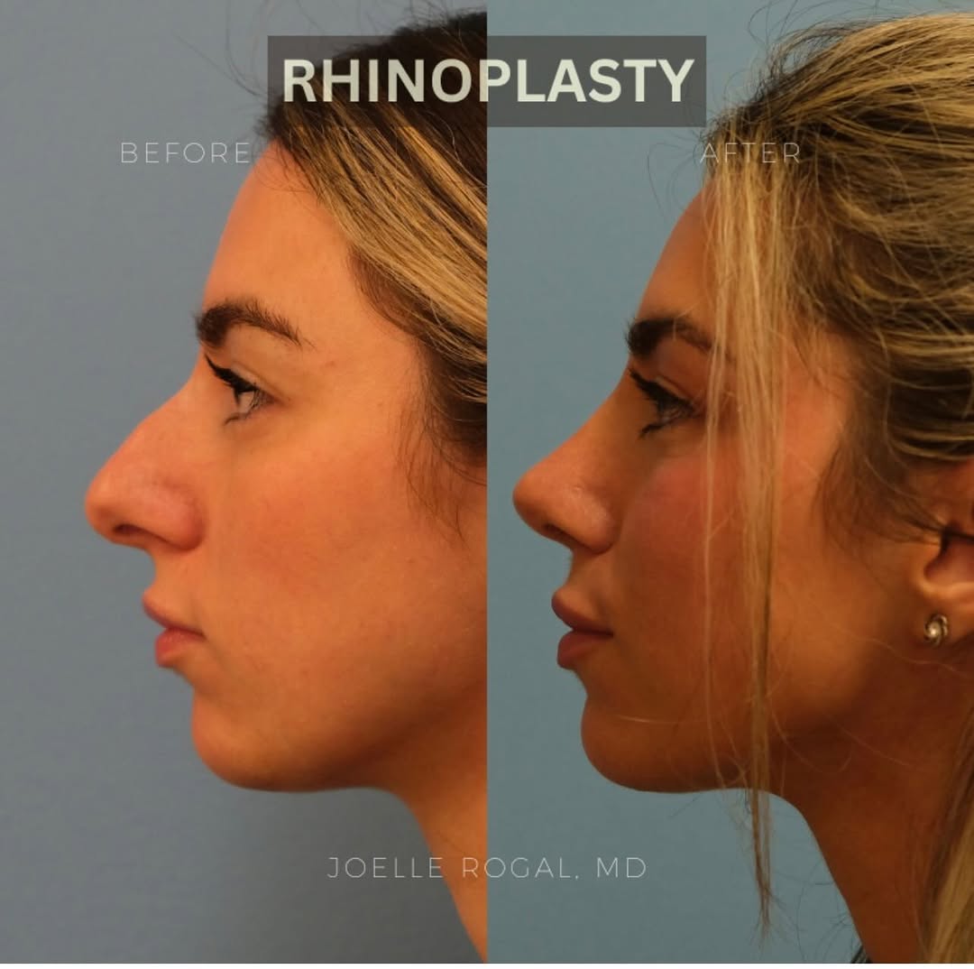 Instagram post by Dr. Joelle Rogal: Before and after a primary cosmetic and functional septorhinoplasty to decrease the dorsal hump, straighten the nose, and improve her breath…