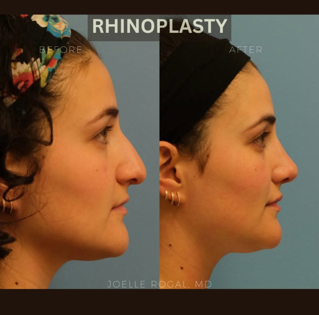 Instagram post by Dr. Joelle Rogal: Six months following a primary cosmetic and functional septorhinoplasty to correct a dorsal hump, droopy nasal tip, and difficulty breathing…