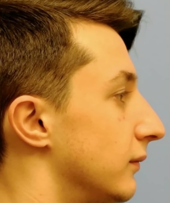 Instagram post by Dr. Joelle Rogal: Swipe to see the transformation ➡️ These male rhinoplasty results by Dr. Rogal showcase subtle refinements designed to create balance while …
