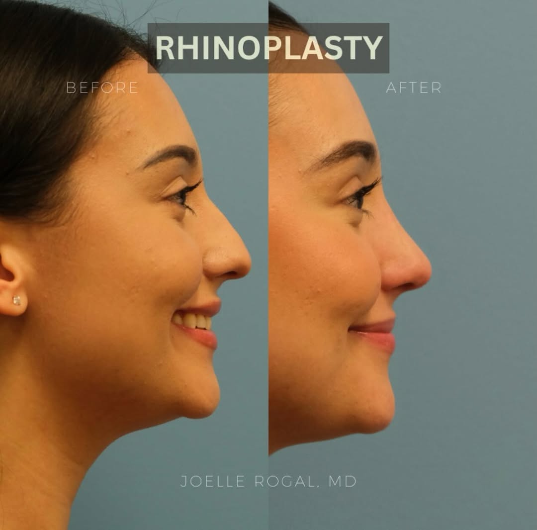 Instagram post by Dr. Joelle Rogal: 1 month postop after a primary septorhinoplasty to straighten the nose, decrease the dorsal hump, refine the nasal tip, and improve breathin…