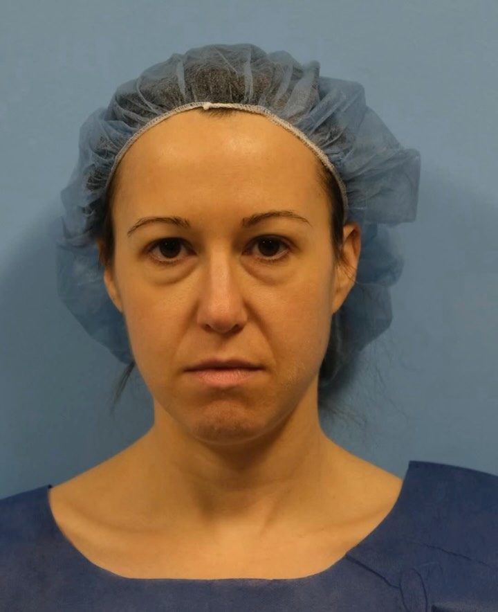 Instagram post by Dr. Joelle Rogal: Wait to see the transformation 👀 A refreshed, natural-looking result following lower blepharoplasty + fat transfer performed by Dr. Rogal. …