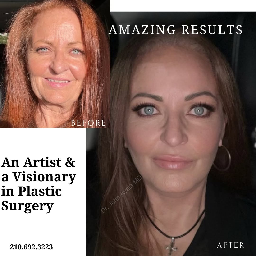 Instagram post by Dr. John A. Ayala: What is a Facelift? A facelift is performed to improve or minimize signs of aging in the lower face and neck, such as wrinkles, facial folds…