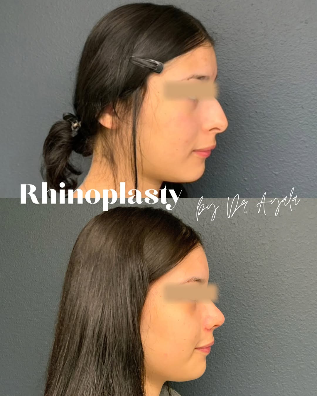 Instagram post by Dr. John A. Ayala: The art of rhinoplasty is in the details. ✨ A refined profile designed to complement—not overpower—her natural beauty. Rhinoplasty by The No…
