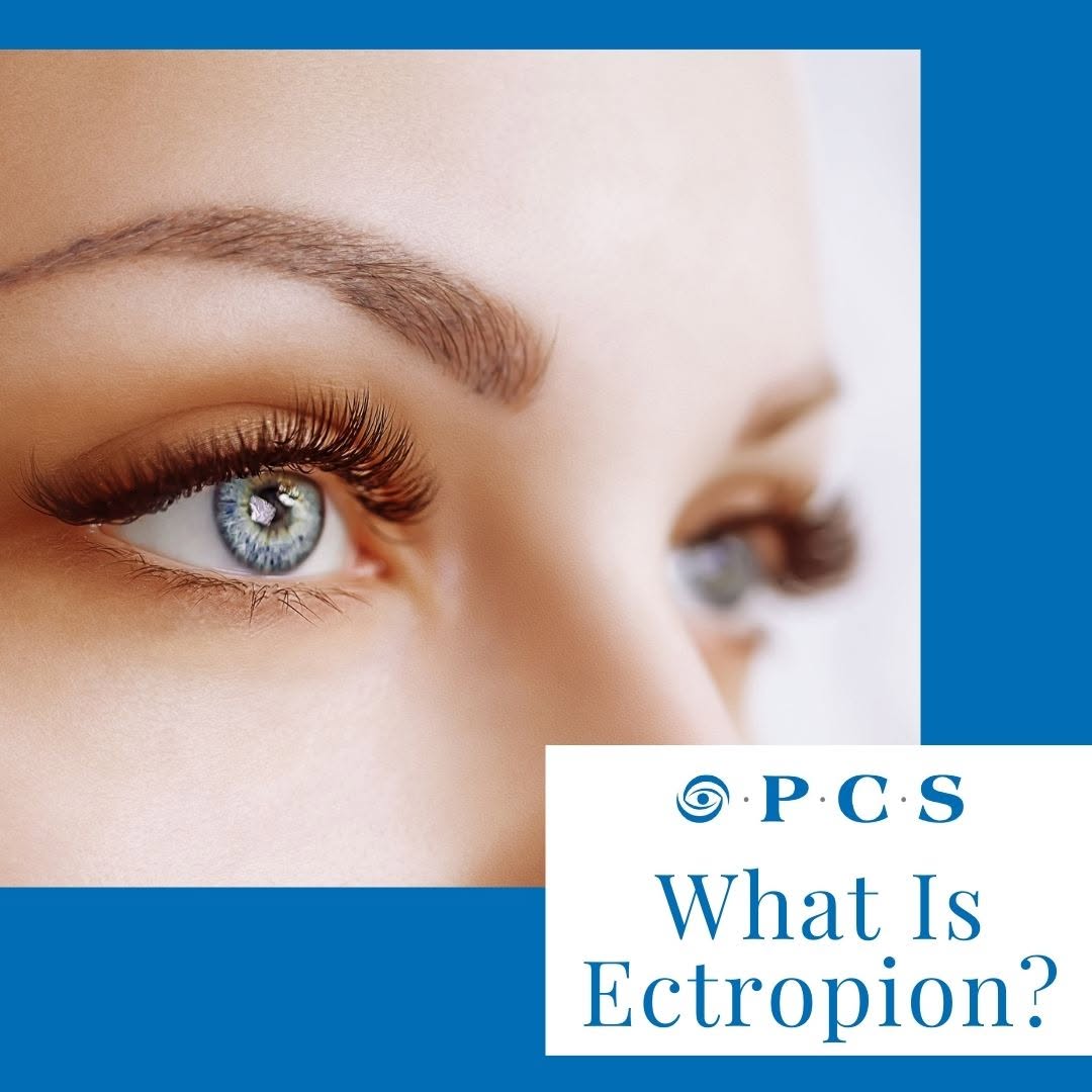 Instagram post by Dr. John B. Holds: Ectropion of the eyelid is a condition when the lower eyelid droops downward and begins to turn out. If your lower lid has begun to turn out…