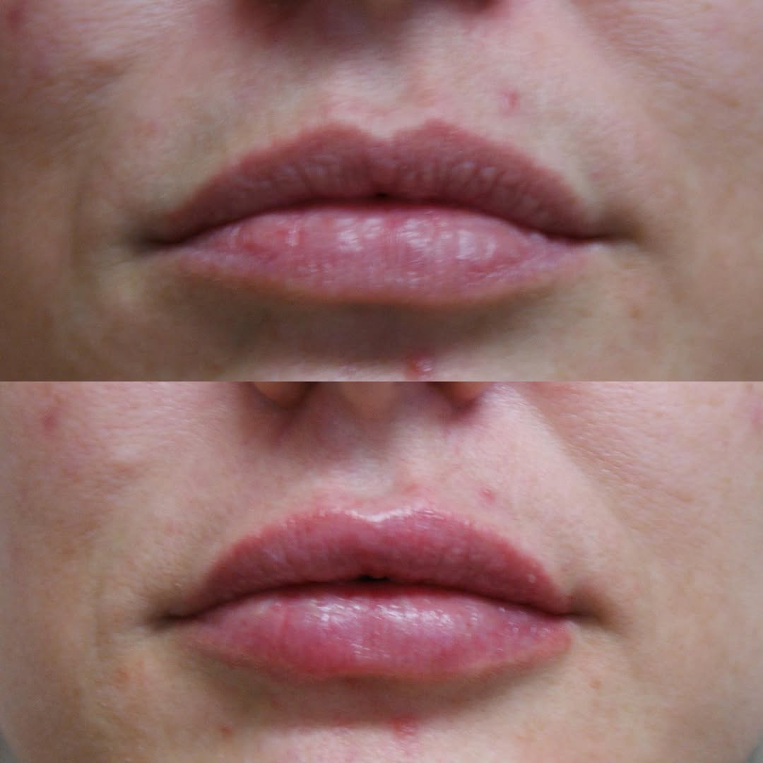 Instagram post by Dr. John Bradford Fisher: When it comes to filler Dr. Fisher strives to give you the most natural results, and he did just that on our wonderful patient💋