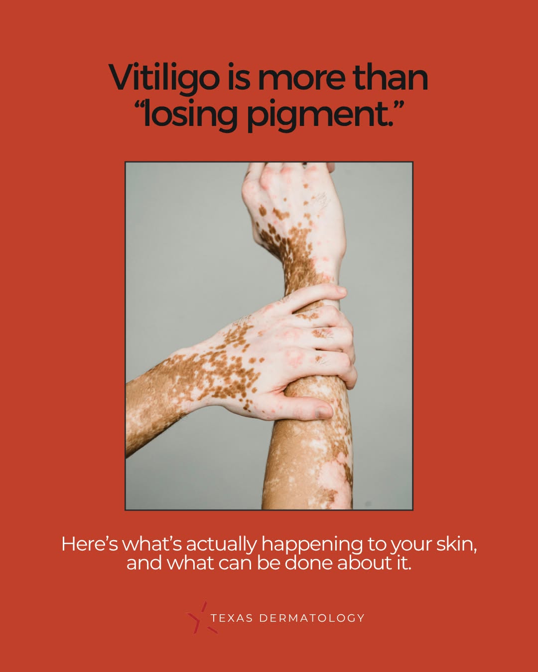 Instagram post by Dr. John C. Browning: If you were told years ago that there wasn’t much you could do about vitiligo, it may be time for a second opinion.⁠ ⁠ Our understanding of …