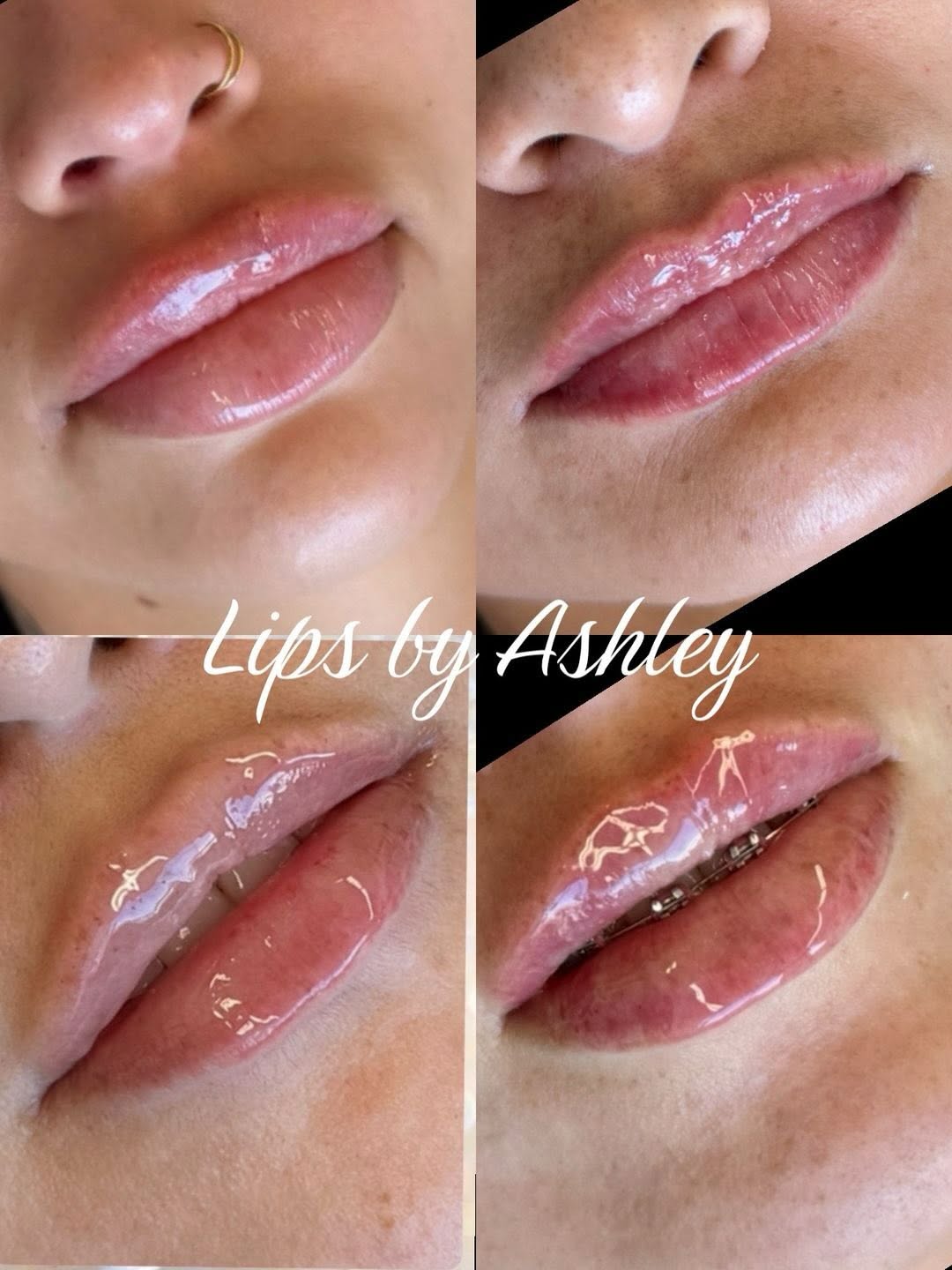 Instagram post by Dr. John C. Ferguson: The glow-up is subtle... but loud🫦💉 Soft luxury lips + just in time for summer Because subtle... still makes a statement. Let’s get you su…