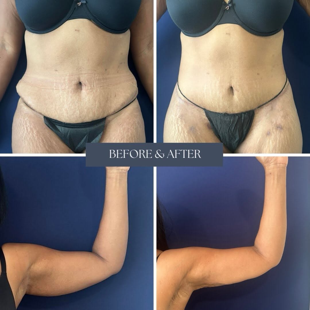 Instagram post by Dr. John Compoginis: Refinement is in the details.🤩 This transformation features a mini tummy tuck with arm liposuction and Renuvion skin tightening to sculpt t…