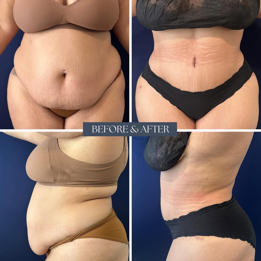 Instagram post by Dr. John Compoginis: 360° transformation, because every angle matters. ✨ This tummy tuck combined with back liposuction creates a smoother, more sculpted contour…
