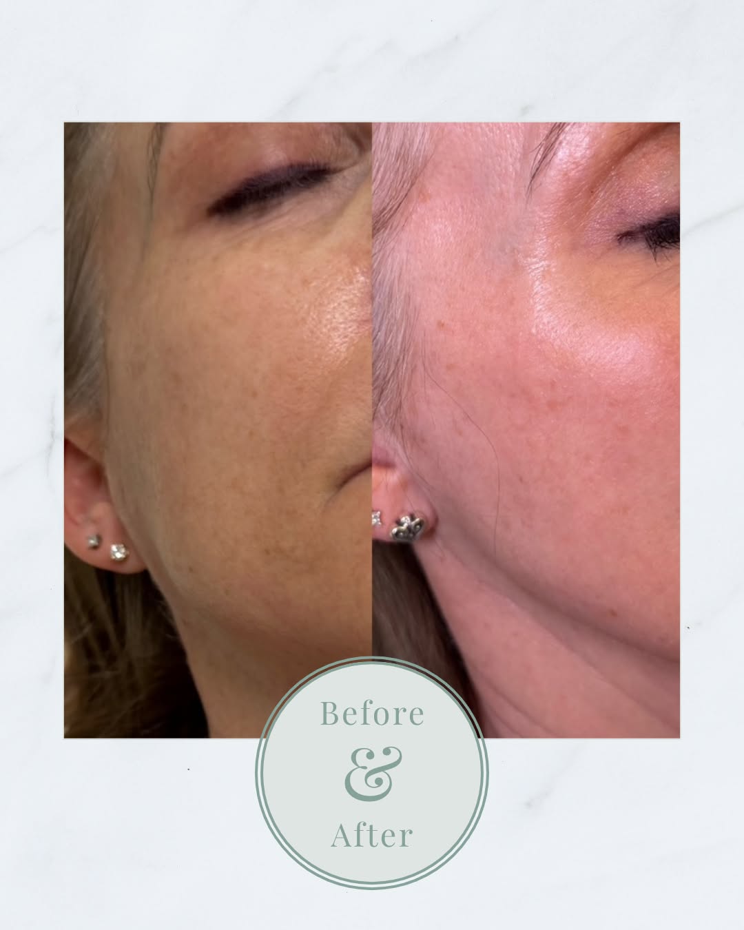 Instagram post by Dr. John D. Symbas: A little refresh can go a long way ✨ This before and after showcases Moxi Advanced, a new feature on our latest Halo Tribrid platform. Moxi …