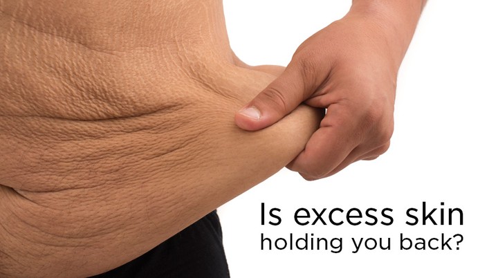 Instagram post by Dr. John Dean: #weightloss following #bariatricsurgery is something to be celebrated - for your looks and your health. #extraskin that remains after weight…