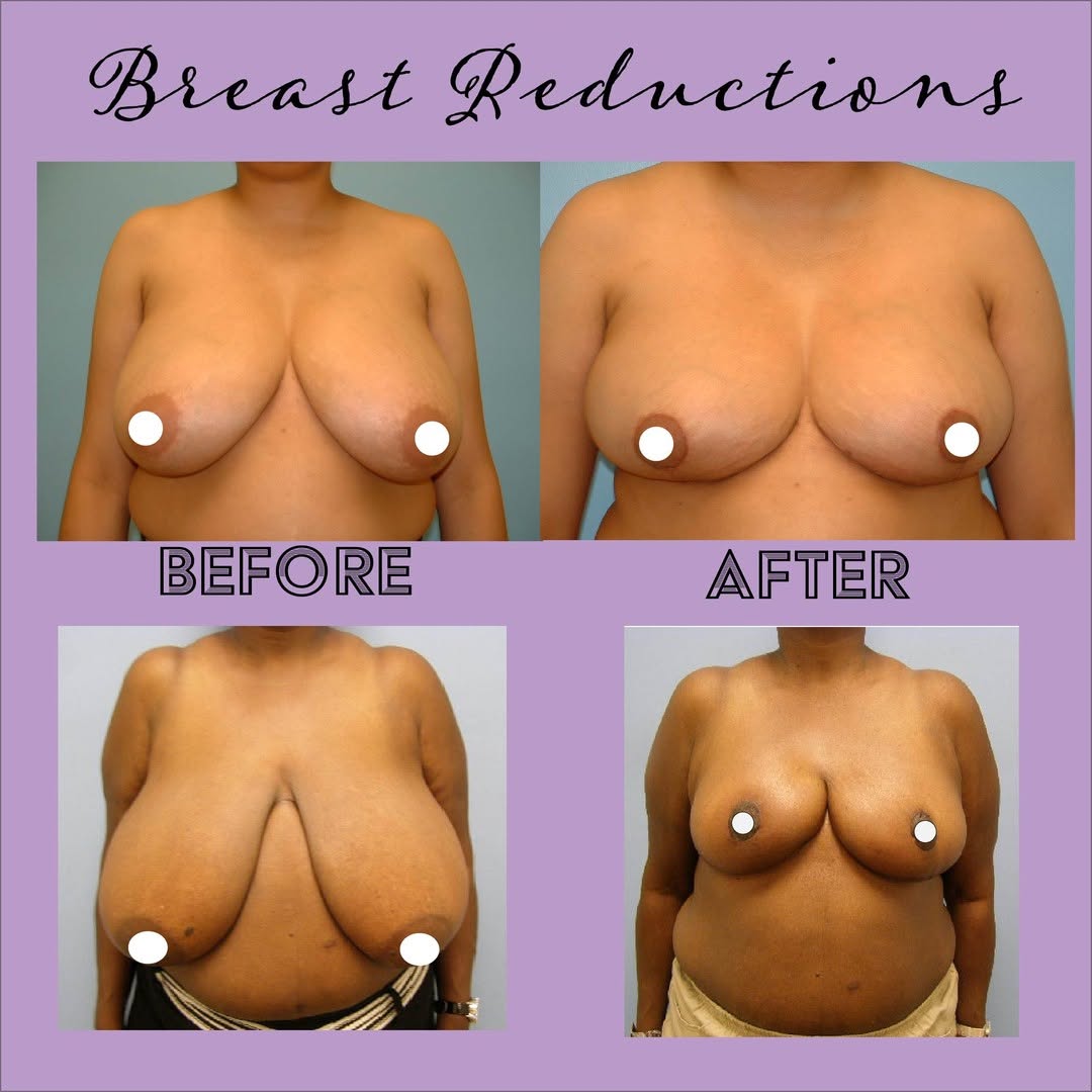 Instagram post by Dr. John Dean: Pictured are two patients who have undergone #breastreduction surgery. These are typically some of my most satisfied patients. They not only…