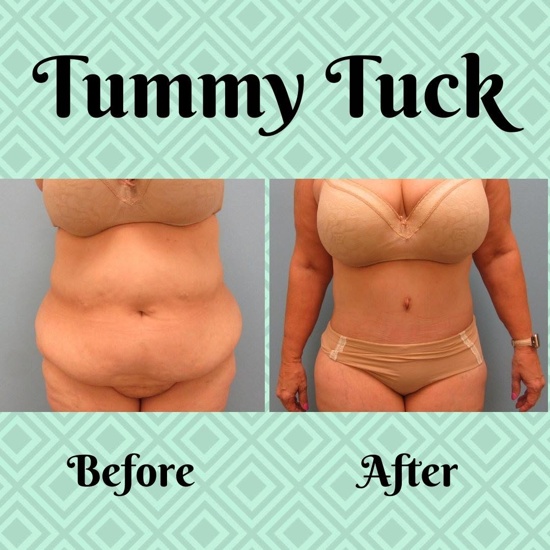 Instagram post by Dr. John Dean: An abdominoplasty or #tummytuck is a cosmetic procedure to improve the appearance of the abdomen. My patients have been pleased with this pr…