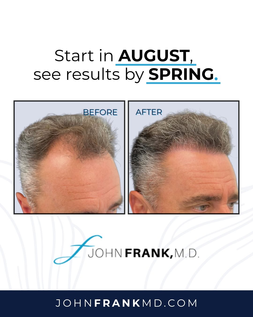 Instagram post by Dr. John E. Frank: Start in August to see results by Spring! 🌿 Hair restoration is a journey that fully matures over 6 to 12 months, which makes late summer t…