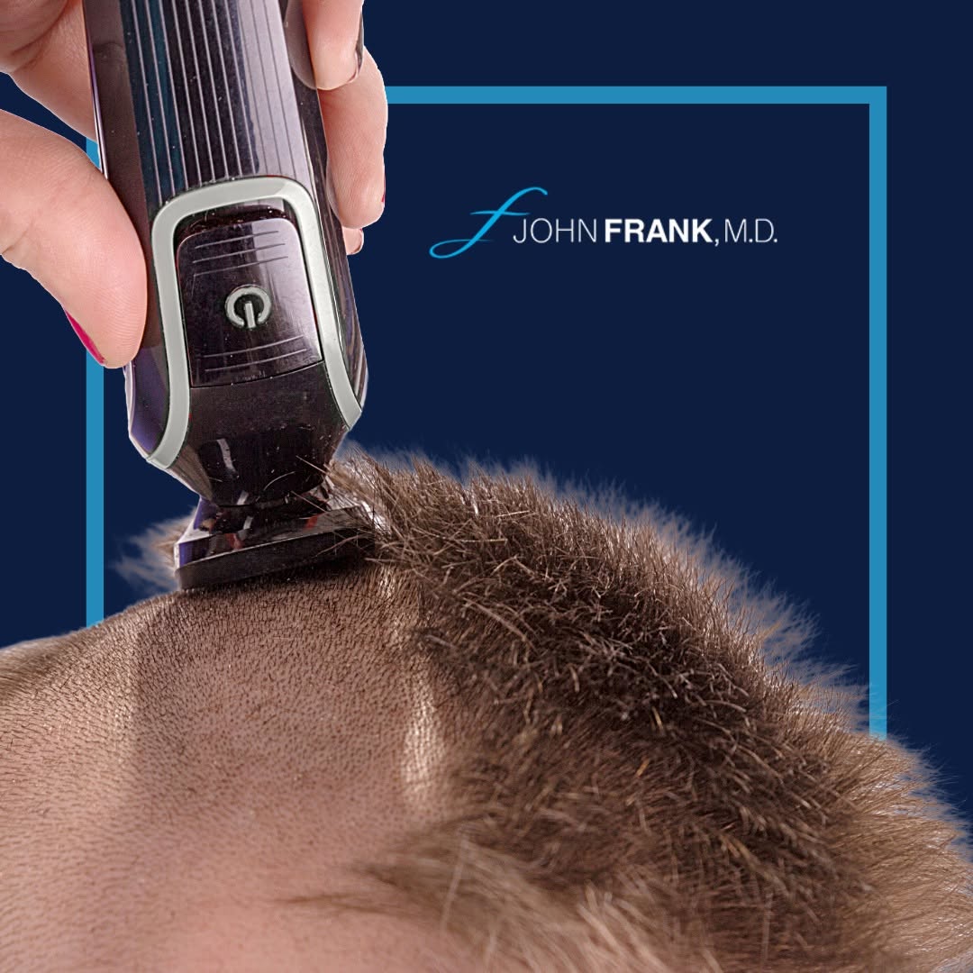 Instagram post by Dr. John E. Frank: Traditional FUE hair transplants often mean shaving your whole head. But with Dr. John Frank, you don't have to! Through No-Shave FUE, we ca…
