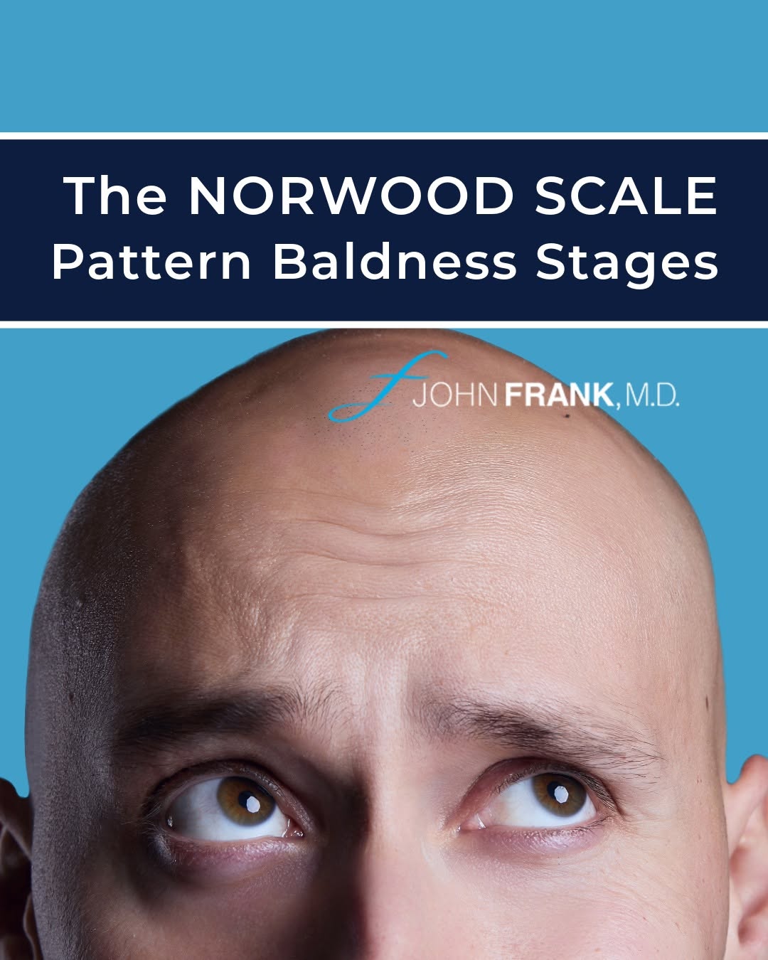 Instagram post by Dr. John E. Frank: Balding rarely happens overnight. To evaluate the severity of #malepatternbaldness, specialists utilize the Norwood Scale - breaking hair lo…