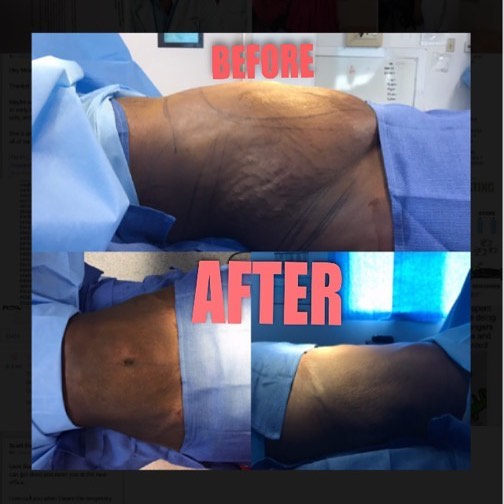 Instagram post by Dr. John E. Nees: Another fabulous liposuction! This patients waist has been snatched! Ready for summer 🌴☀️ #plasticsurgeon #boardcertified #snatched #drnees…